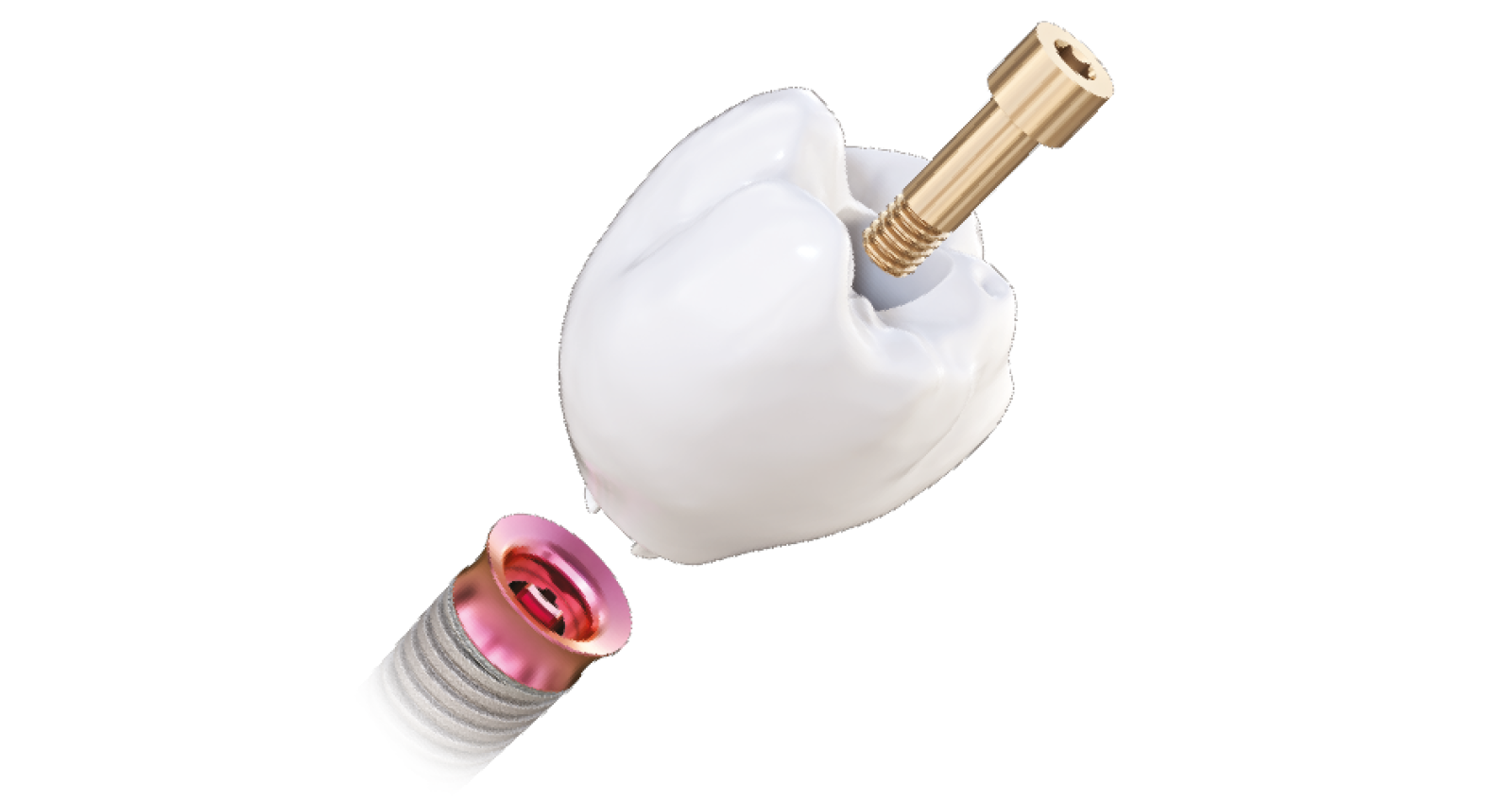 Implant dentar TRI TISSUE LEVEL MATRIX