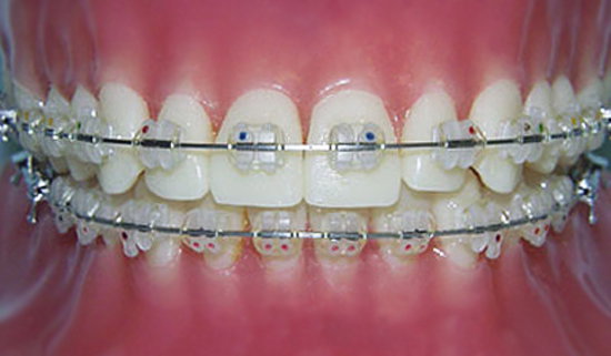 Arcuri ortodontice oţel rotund - Premier Denta