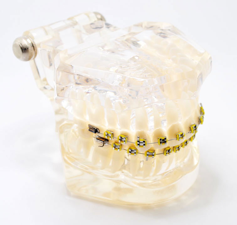 Model typodont orto transparent bracketi metalici tipodont - Premier Denta