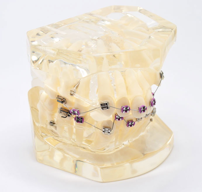 Model typodont orto patologic dinti malpozitionati tipodont tip 1 - Premier Denta